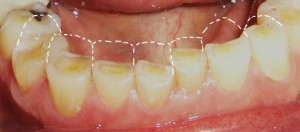 Teeth Grinding Results